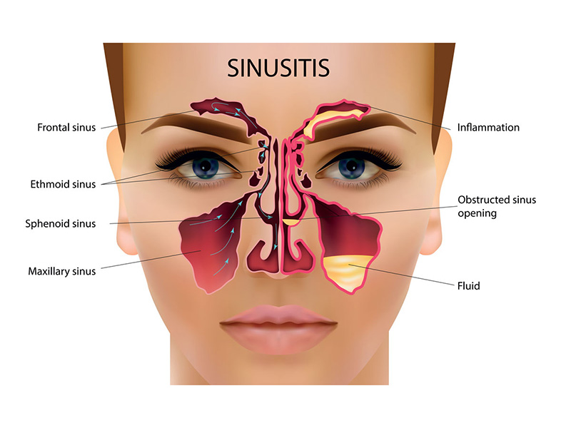 A visual representation of sinus drainage pathways impacted by sinusitis in St. Peters, MO